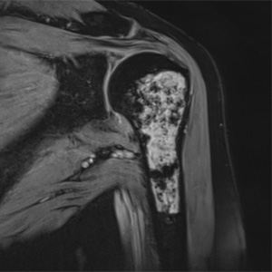 Schultertumor