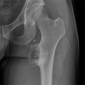 Tumor des Oberschenkels
